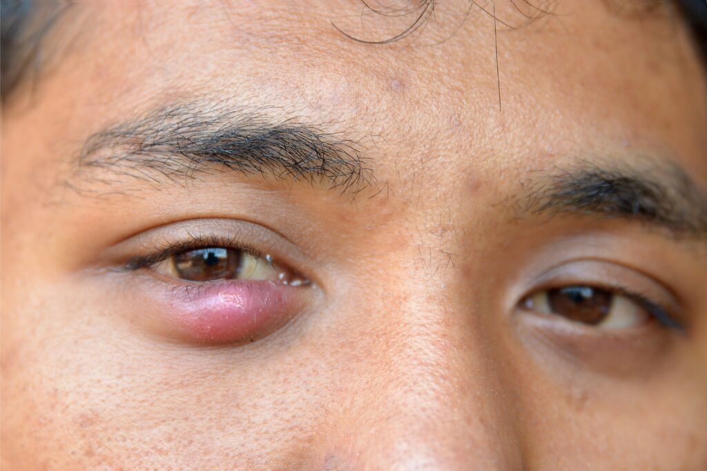 Homem com terçol no olho direito.